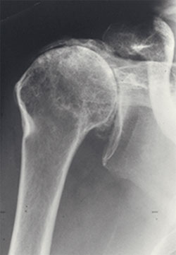 Artropatia do Manguito Rotador Radiografia mostrando artropatia do manguito rotador — migração superior da cabeça do úmero