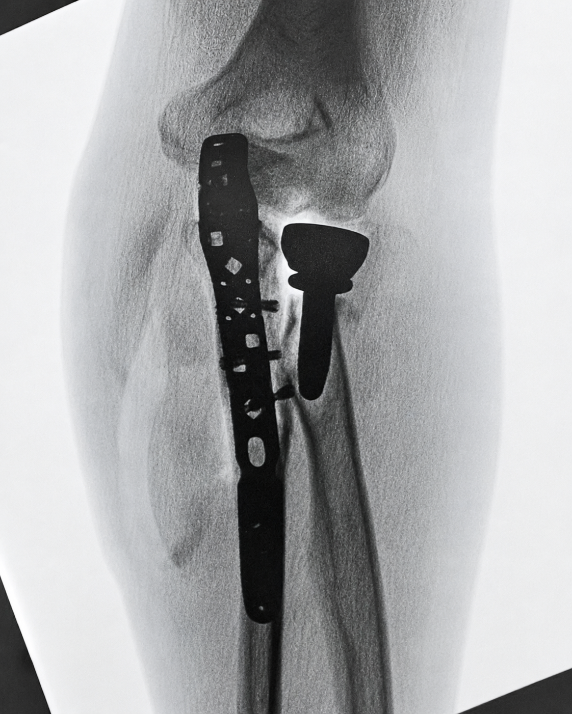 Fraturas Complexas do Cotovelo Pós-operatório de fratura complexa do cotovelo — fixação da ulna proximal