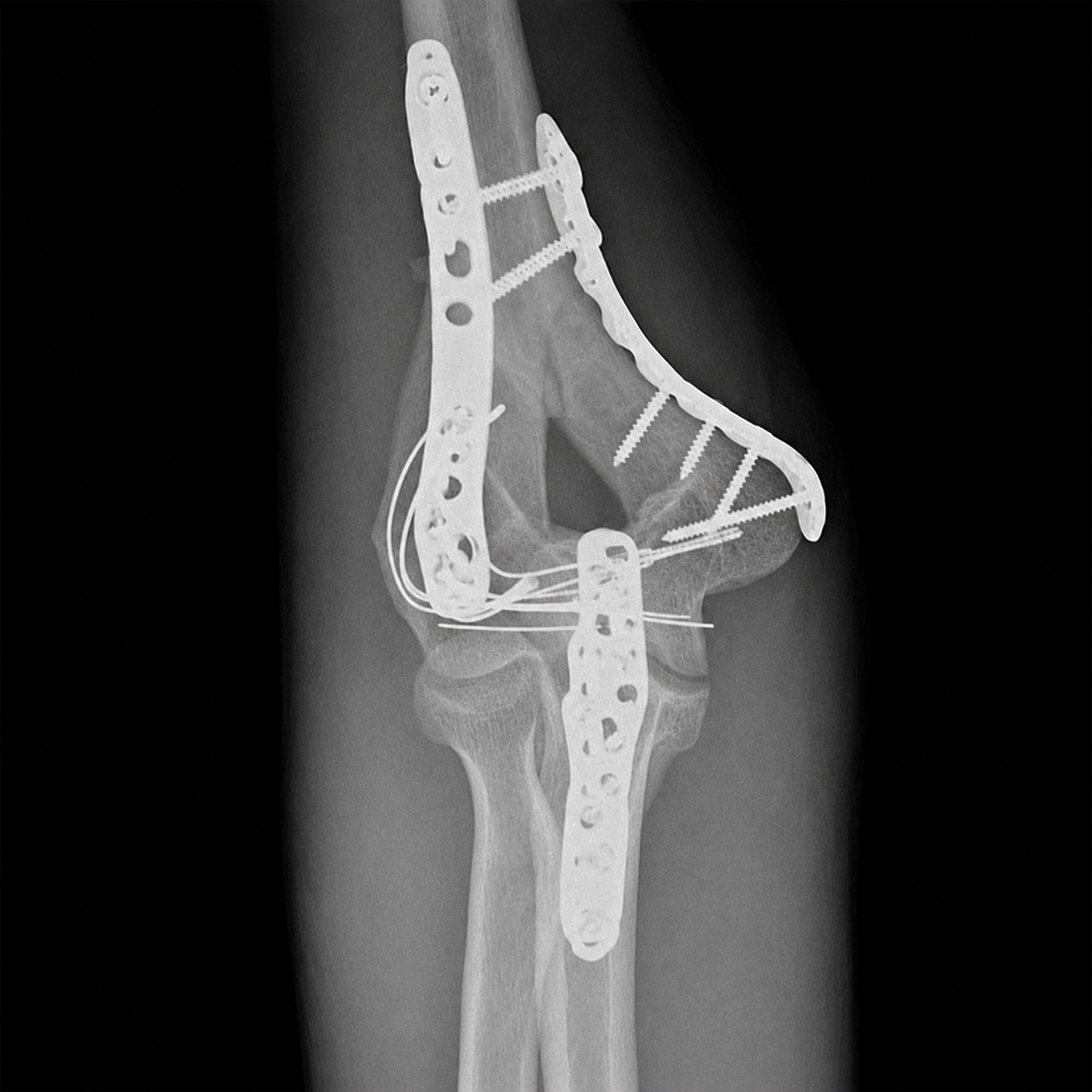 Fratura do Úmero Distal Pós-operatório de fixação da fratura do úmero distal com placas