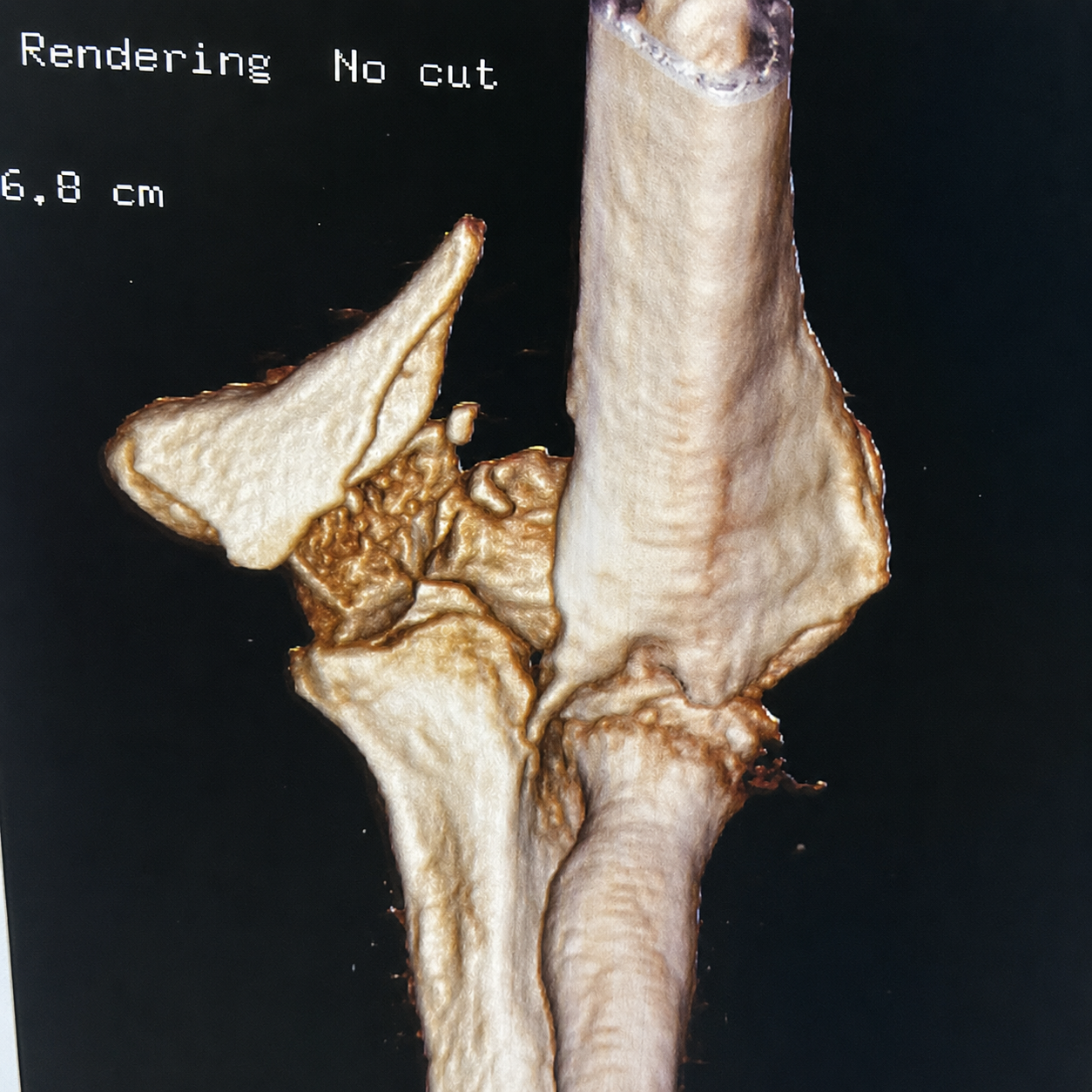 Fratura do Úmero Distal Radiografia pré-operatória de fratura do úmero distal