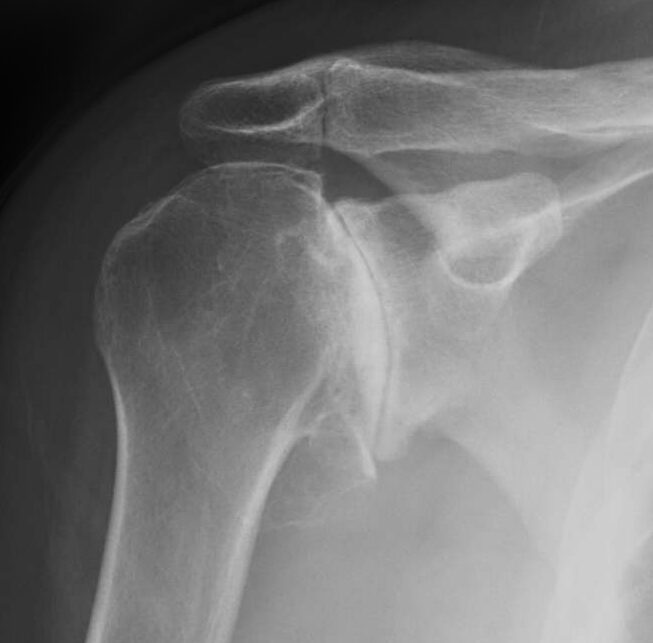 Artrose do Ombro Radiografia de ombro com artrose glenoumeral avançada