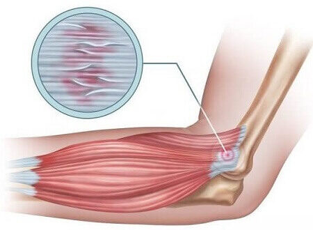 Epicondilite Lateral e Medial (Cotovelo de Tenista e de Golfista) Epicondilite lateral (cotovelo de tenista)