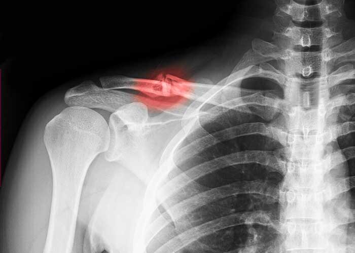 Radiografia com fratura do terço médio da clavícula