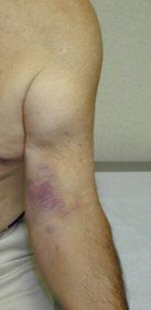 Retração distal do bíceps