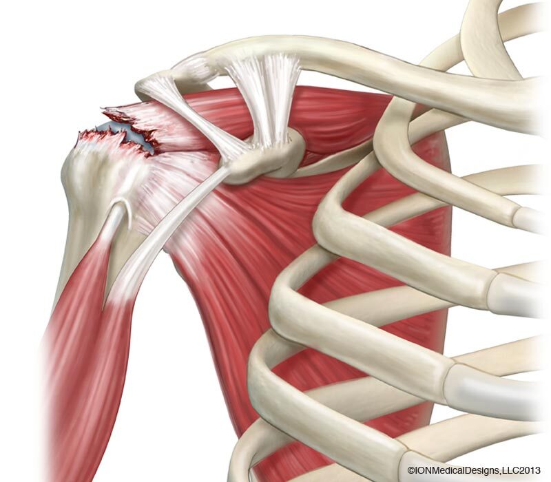 Tendinopatia e Lesão do Manguito Rotador Anatomia do manguito rotador com ruptura tendínea