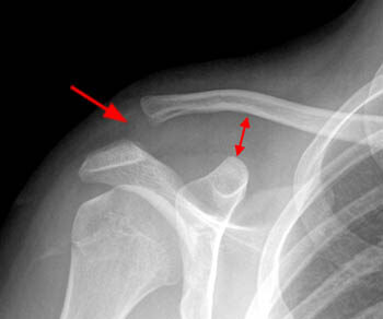 Luxação da articulação acromioclavicular