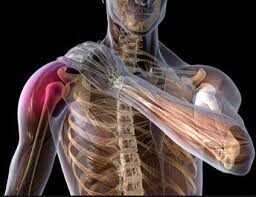 Bursite subacromial e inflamação tendínea do ombro