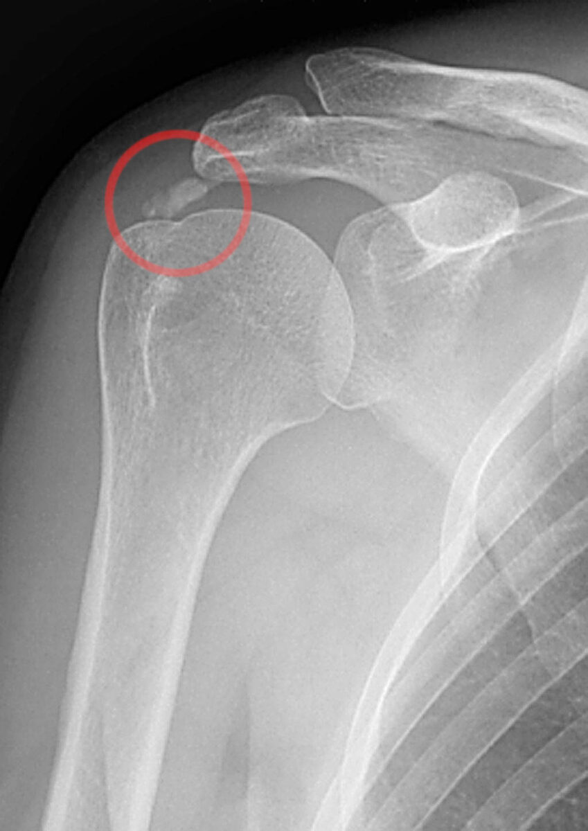 Tendinite Calcárea do Ombro Radiografia de ombro com depósito calcário no tendão do supraespinal